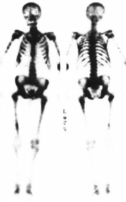 TechneScan HDP: scintigrafie skeletu