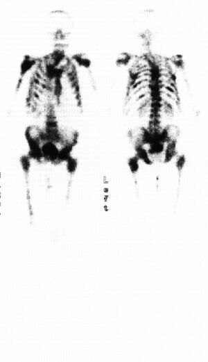 Re-Bone: paliativn terapie metastz