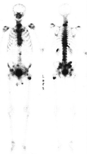 TechneScan HDP: scintigrafie skeletu