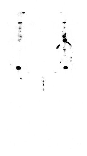 Re-Bone: paliativn lba metastz